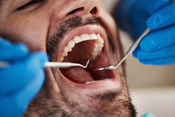 Best Emergency Dentist for Lost Fillings or Crowns in Conyers, GA